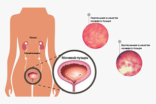 Комплексное лечение цистита у женщин